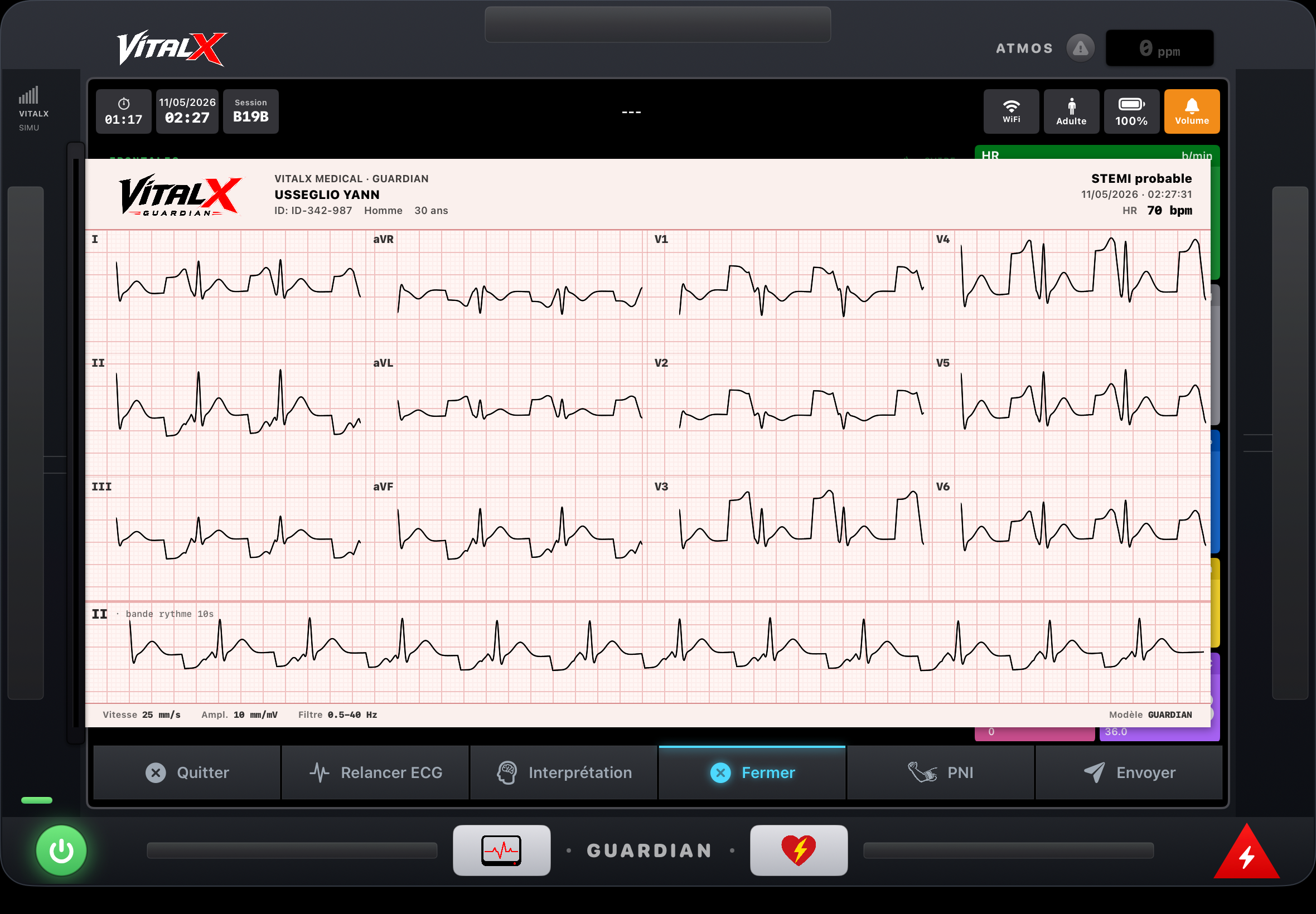 ECG 12D